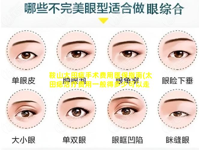 鞍山太田痣手术费用医保指南(太田痣治疗费用一般得多少可以走 🐟 医保吗)